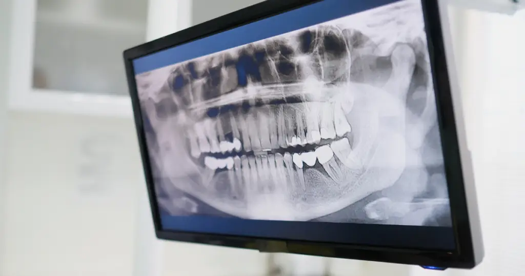 Will dental implants affect MRI