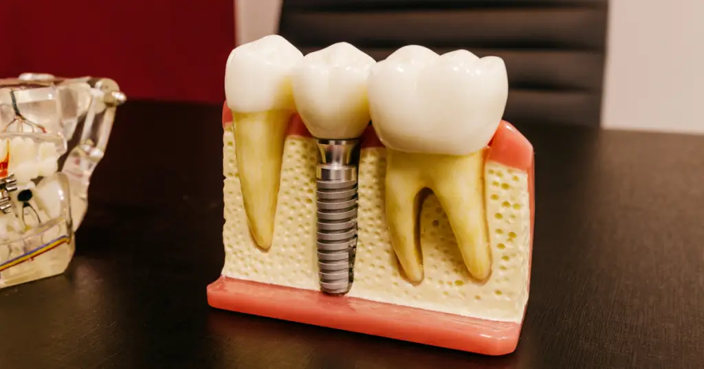 Can dental implants cause sinus problems