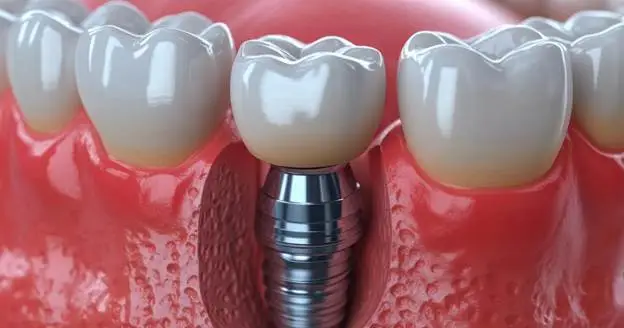 can dental implants be covered by medical insurance